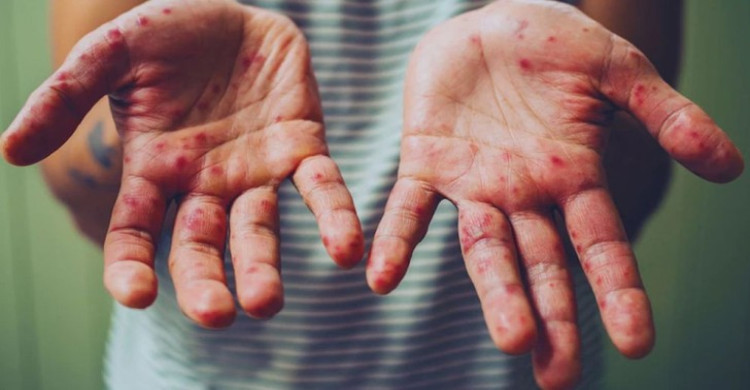 নাটোরে হামের উপসর্গে হাসপাতালে ভর্তি ২১